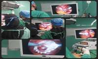 First Laparoscopic Gallbladder Surgery Successfully Conducted at Fatemeh Zahra Hospital